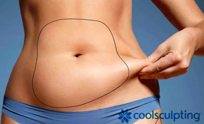 Coolsculpting à Lyon