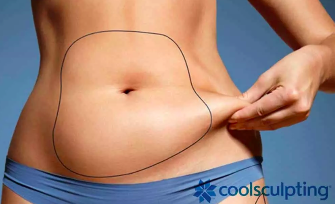 Coolsculpting à Lyon 