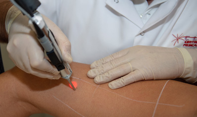 Epilation définitive au laser