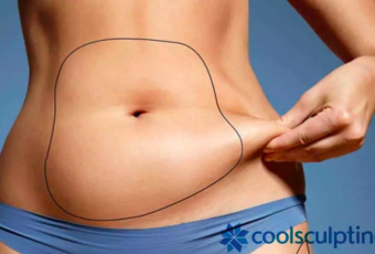 Coolsculpting à Lyon 